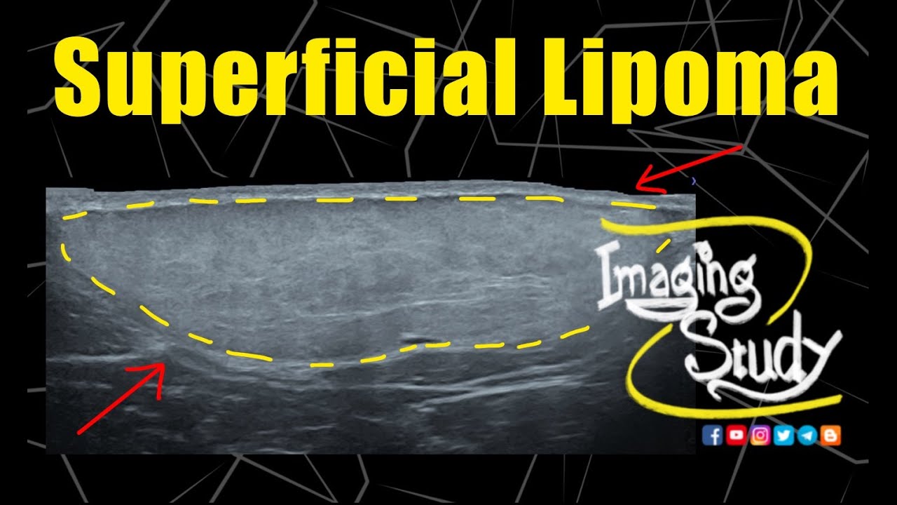 Superficial Lipoma Ultrasound Case 325 YouTube Superficial Lipoma Ultrasound Case 325 YouTube
