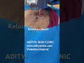 Chest Keloid Treatment with CO₂ .LaserSafe • Effective • Dermatologist-guided.