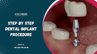 Step by Step Dental Implant Procedure