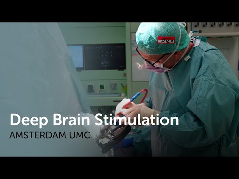 Deep Brain Stimulation: Hoe werkt het en wat doet het?