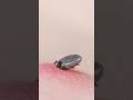 How to remove a tick
