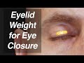 Gold or Platinum Eyelid Weight to Treat Incomplete Eye Closure in Facial Paralysis