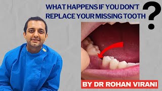 What Happens If You Don't Replace Your Missing Tooth - BY DR ROHAN VIRANI