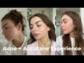 ACNE & EPURIS (ACCUTANE) EXPERIENCE | journey & side effects
