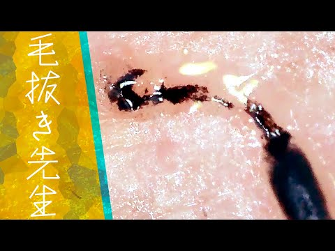 409 Ink is flowing out of the roots of the hair 毛抜き先生の角栓や毛根