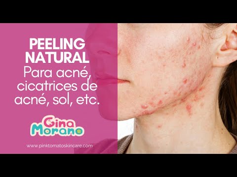 Peeling din piele varicoză vene - Cum să tratezi peelingul pielii pe picioare cu varice