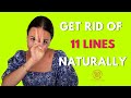 How to get rid of 11 lines naturally? [Using Face Yoga]