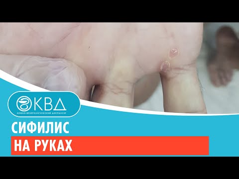 ✋✋ Сифилис на руках. Клинический случай №584