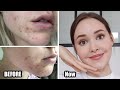 How To Really Get Rid Of Acne (& texture/acne scars/skin damage) *Adult Hormonal Acne*
