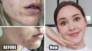 Acne] Significantly Worsened Months Ago, Need Help To, 47% OFF