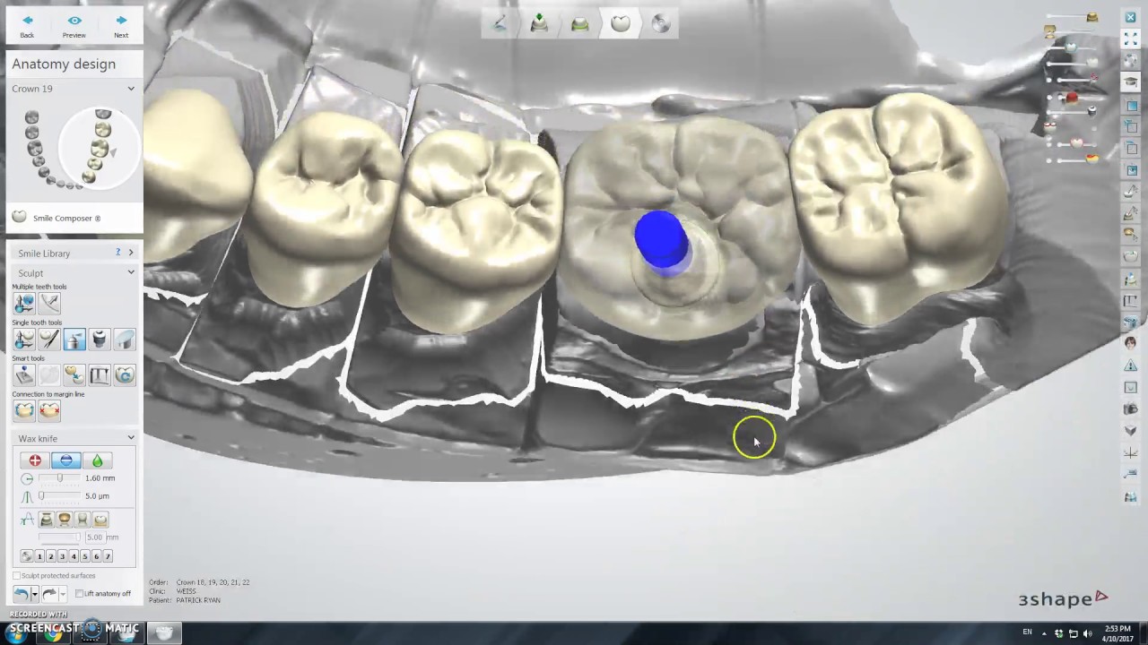 3shape design of hybrid full contour crown without implant license ...