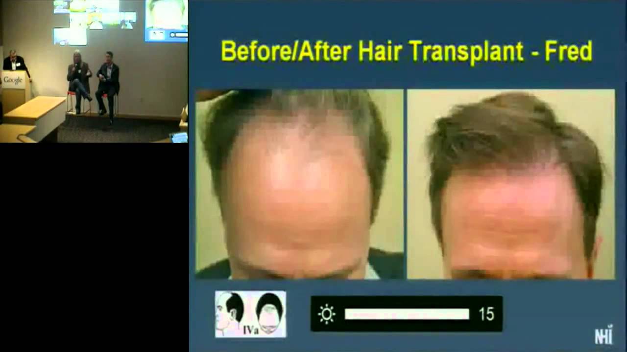 Health@Google Series: Hair Loss and Hair Restoration