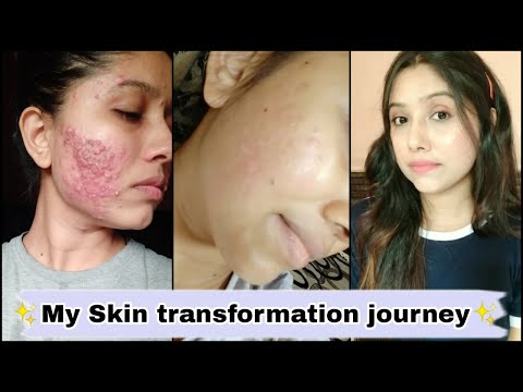 My skin transformation journey / Cystic acne , red scar #shorts