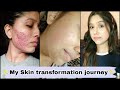 My skin transformation journey / Cystic acne , red scar #shorts