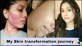 My Skin Transformation Journey Cystic Acne Red Scar 