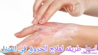 الطريقه الصحيحه والمجربه لعلاج الحروق في المنزل