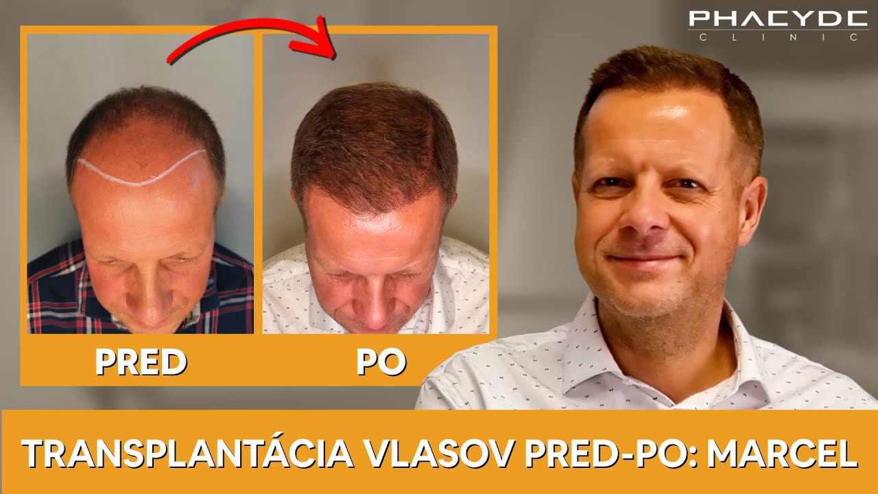 Transplantácia vlasov pred-po: Marcel - PHAEYDE Clinic
