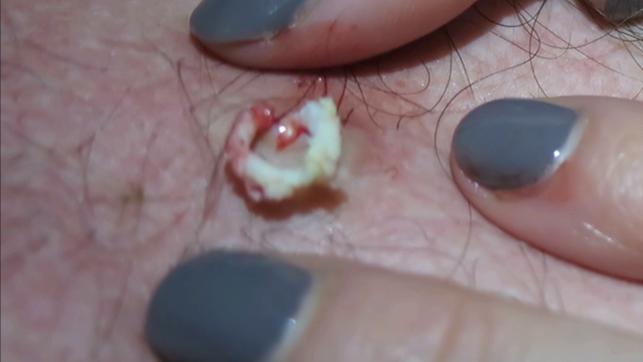 Cyst on dick