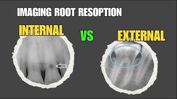 Root Resorption|Types of Resorption Internal or External Root Resorption|Radiographic Interpretation