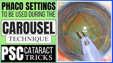 The carousel technique phaco in a PSC cataract & Understanding the phaco settings - Dr. Deepak Megur