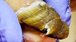 Download Lagu Long And Curled Onychomycosis With A Lot Of Fungi Inside【Pedicure King】 MP3 Download Lagu Long And Curled Onychomycosis With A Lot Of Fungi Inside【Pedicure King】 MP3