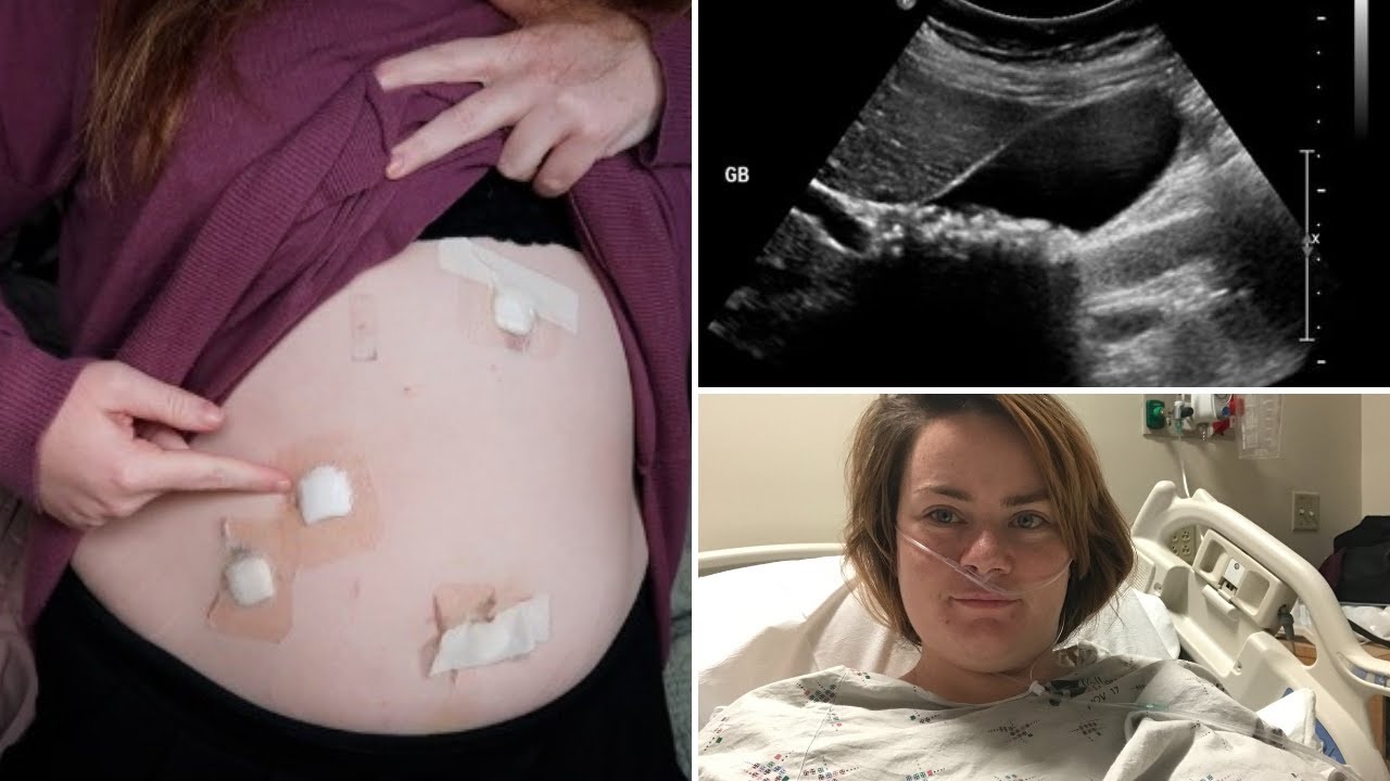 MY SURGERY STORY | Gallbladder Removal Surgery