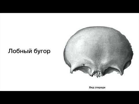 Гиперостоз Лобной Кости Фото
