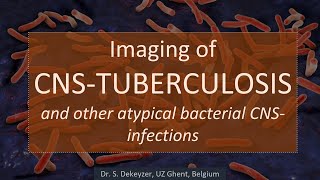 Imaging of CNS-Tuberculosis (and other atypical bacterial infections of the brain).