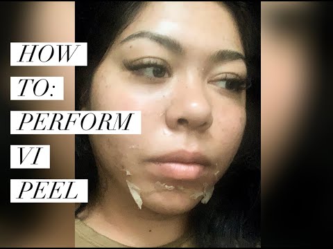 How to: Perform a VI PEEL step by step (in depth tutorial)