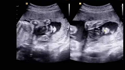 Taylor Marie Howlett's ultrasound at 27 weeks