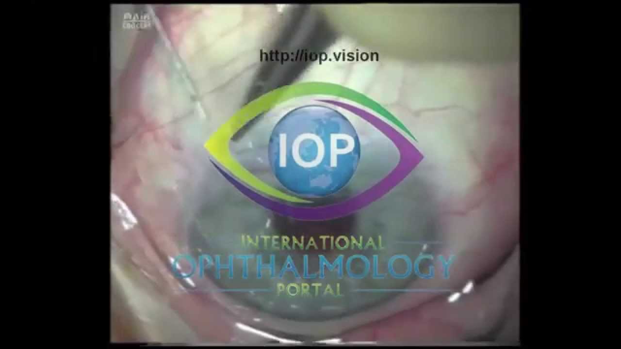 Bleb Needling 1 Preview YouTube