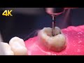 Caries dental siendo removida en GRAN aumento 4k