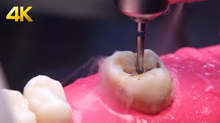 Tooth decay being removed in BIG 4K magnification