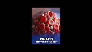 Blood Clots What You Need to Know #shorts