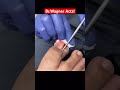 ENORMOUS INGROWN TOENAIL REMOVAL Shorts 