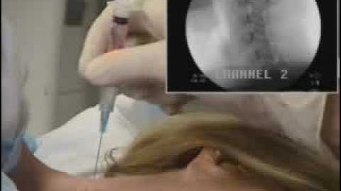 Cervical Facet Joint Injection - PalmHarborOrtho.com