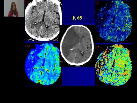 CT perfuzija mozga, Biljana Georgievski 1_02