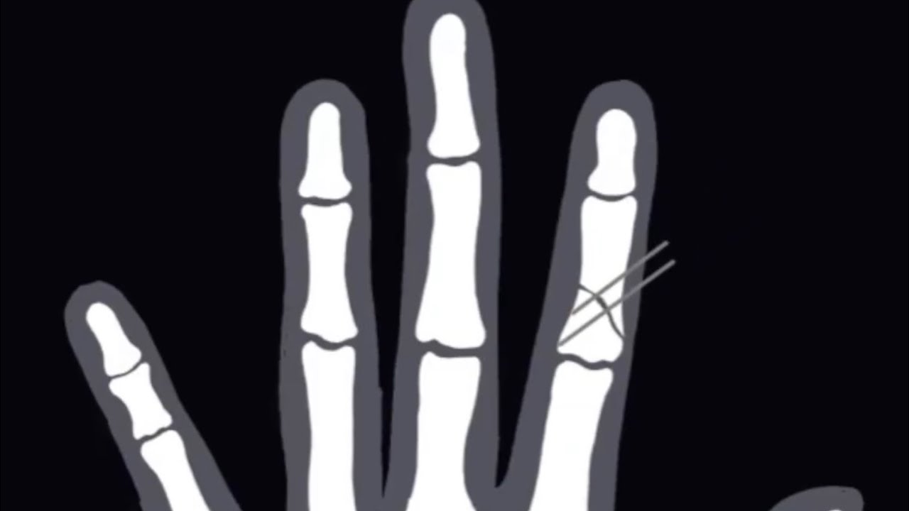 Уход за спицами Киршнера