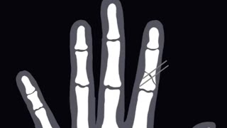 Caring for your K-wires