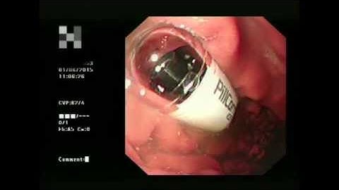 Capsule Endoscopy: a helping hand