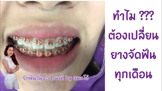 เทคนิค การคล้องยางของคนจัดฟัน/รักฟันวันละ1นาทีByหมอโอ๋ - Youtube