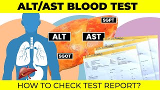 ALT AST Blood Test | liver function test | #hepatitis