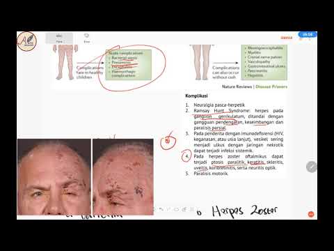 Video: Pencegahan Cacar Air: Cara Menghindari Virus Varicella-Zoster