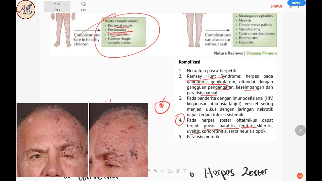 Virus Varicella Zoster : Varicella (Cacar Air) dan Herpes Zoster