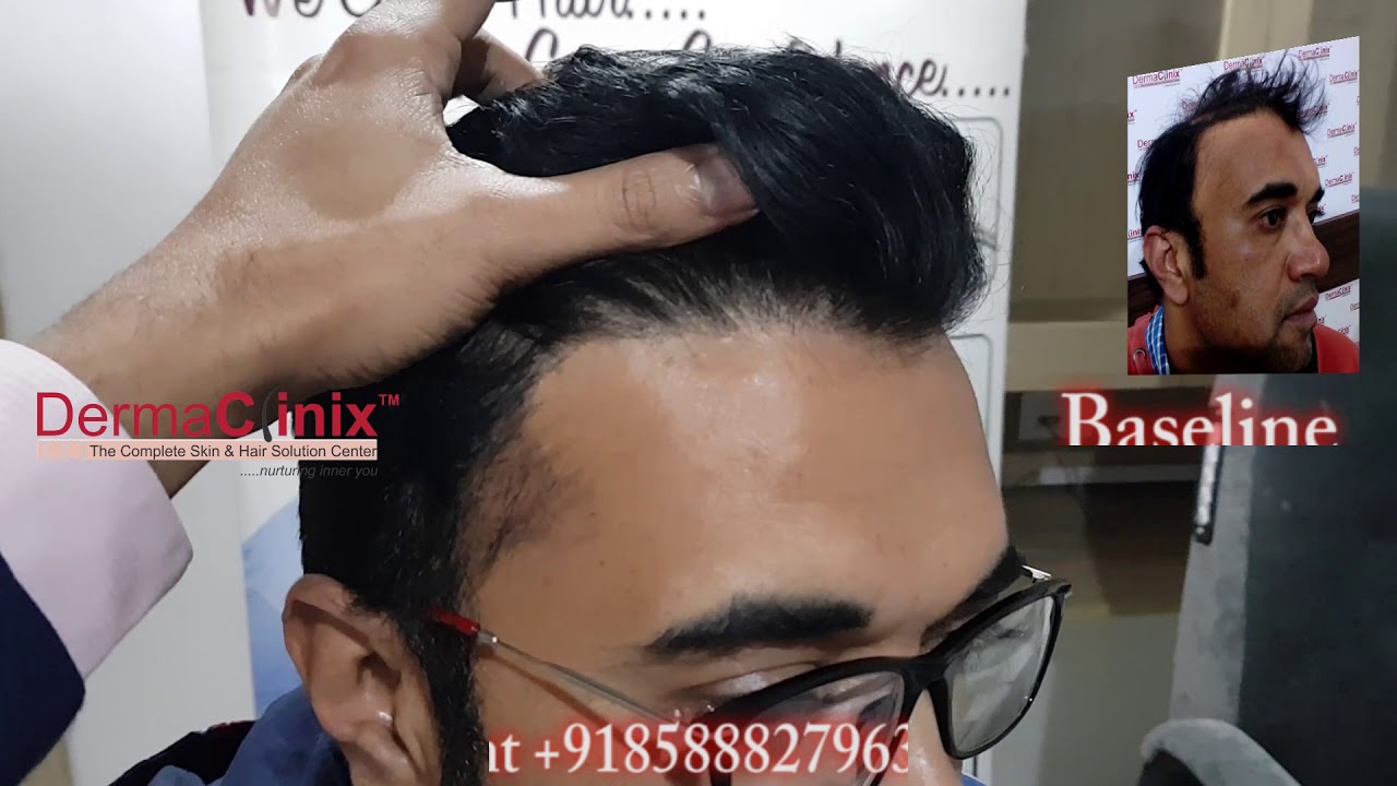 Best Hair Transplant Clinic in Indore Hair Loss Treatment Doctor in Indore  Bhopal India