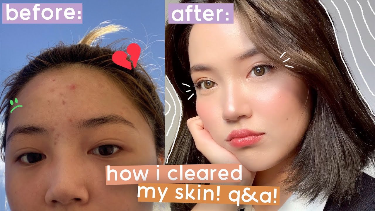 how i cleared up my skin q&a + current skincare routine!! - YouTube