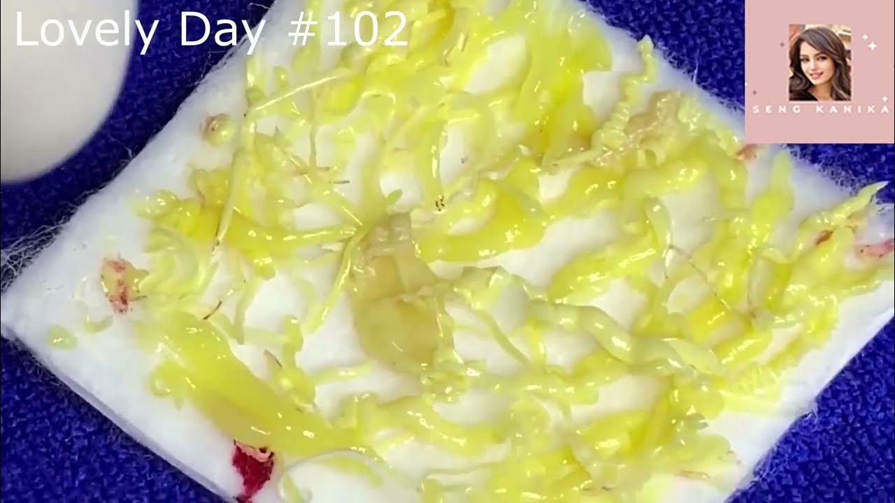 Lovely Day 102 Seng Kanika How to Get Rid of Blackheads Without