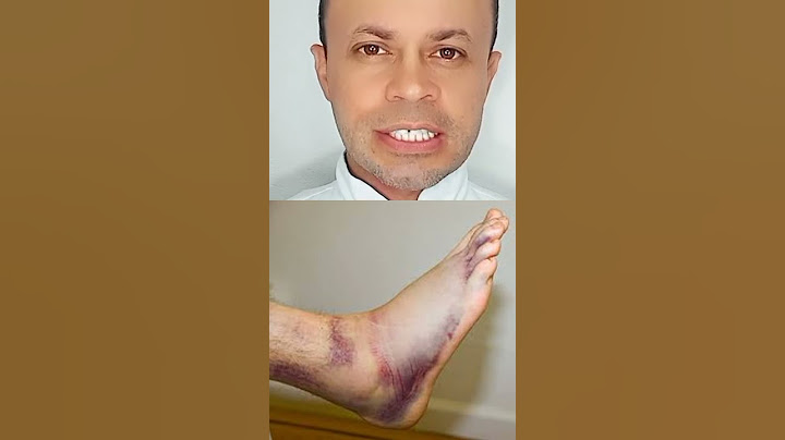 Torção no pé - nunca faça isso.