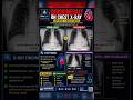 Cardiomegaly on Chest X-Ray Explained | CTR greater 50% | Normal vs Enlarged Heart