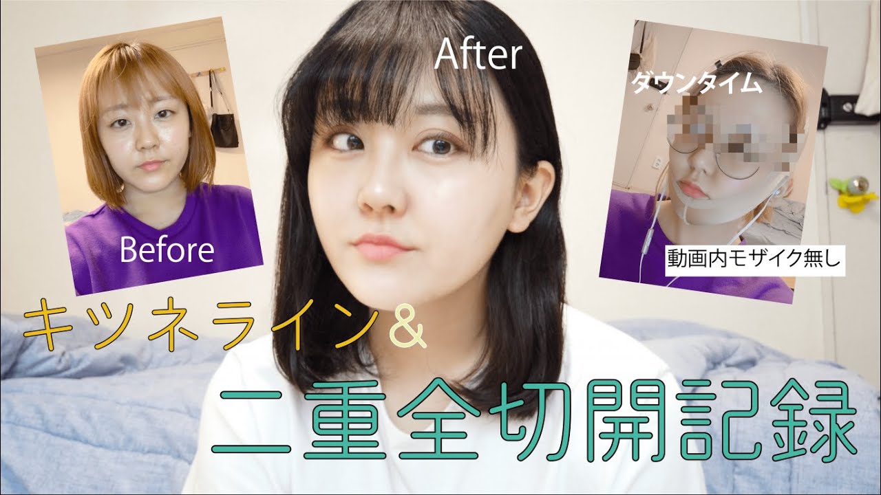 【長編記録】二重全切開整形&キツネライン整形しました！【記録】